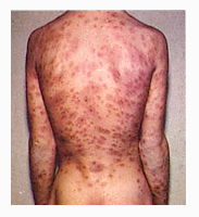 AIDS 감염환자 사진