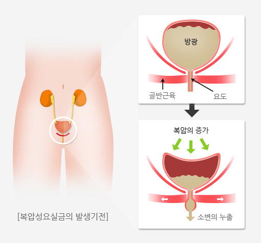복압성요실금 사진