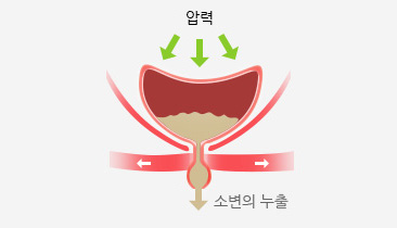 혼합성요실금 사진